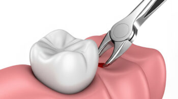 When is a Tooth Extraction Necessary?