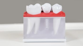 Choosing Between Single Tooth Implants and Full-Mouth Reconstruction